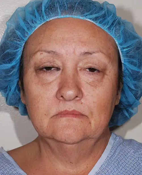 Middle-aged woman wearing a blue medical hair cover and hospital gown, with tired eyes and neutral expression.