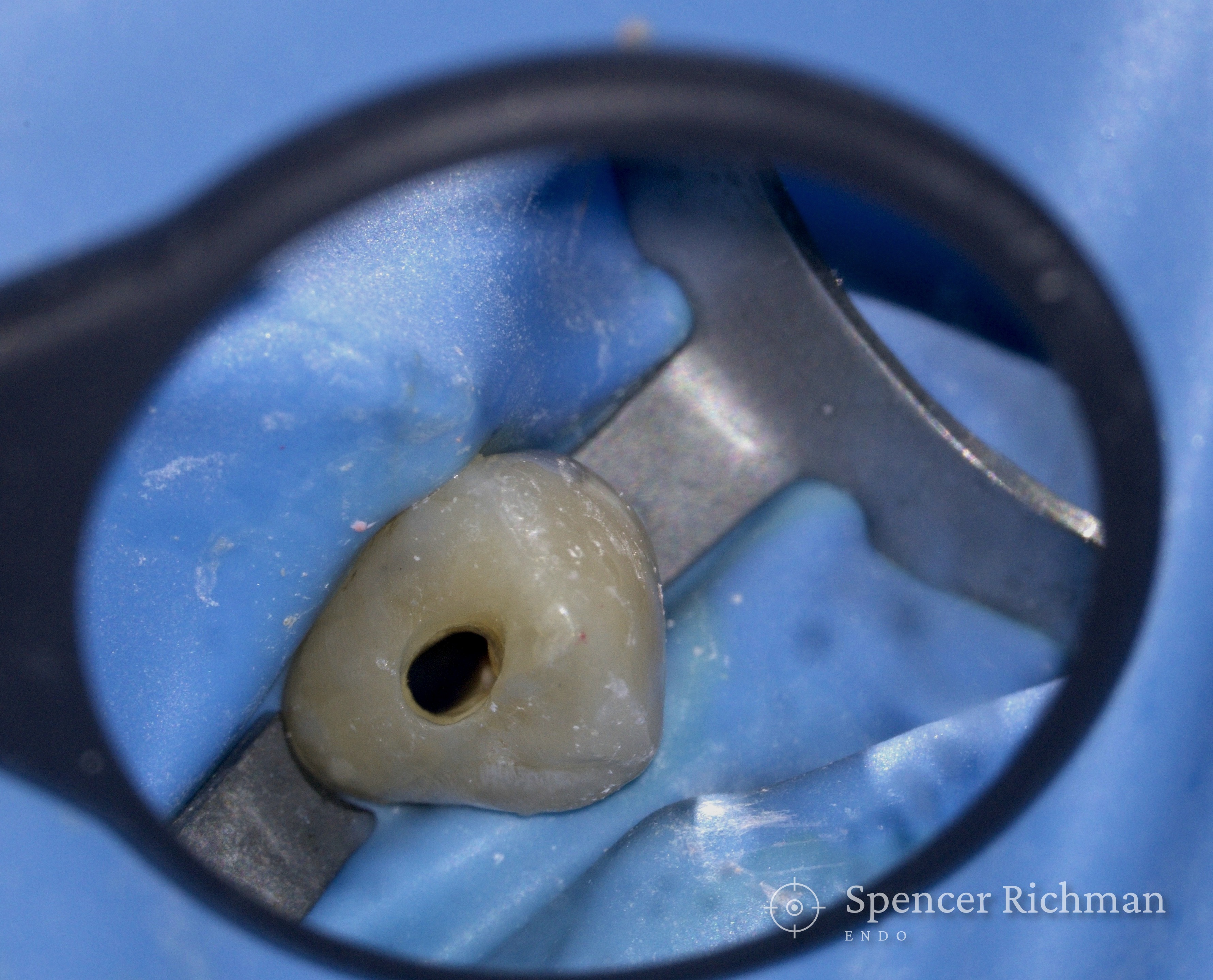 Upper canine isolated under rubber dam, viewed through a dental operating microscope during root canal re-treatment