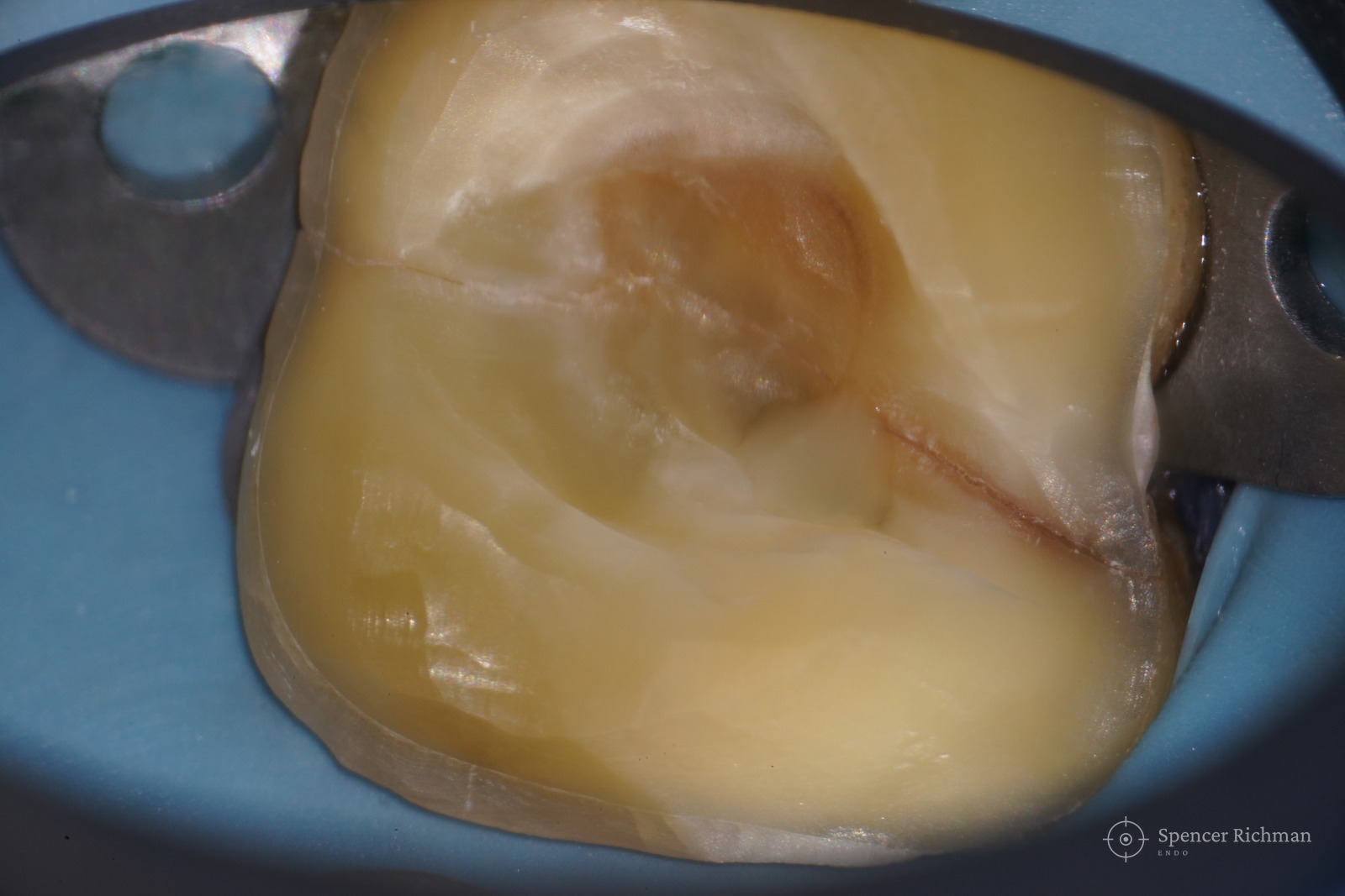 A cracked molar isolated under a dental operating microscope, with a stained fracture line running across the tooth