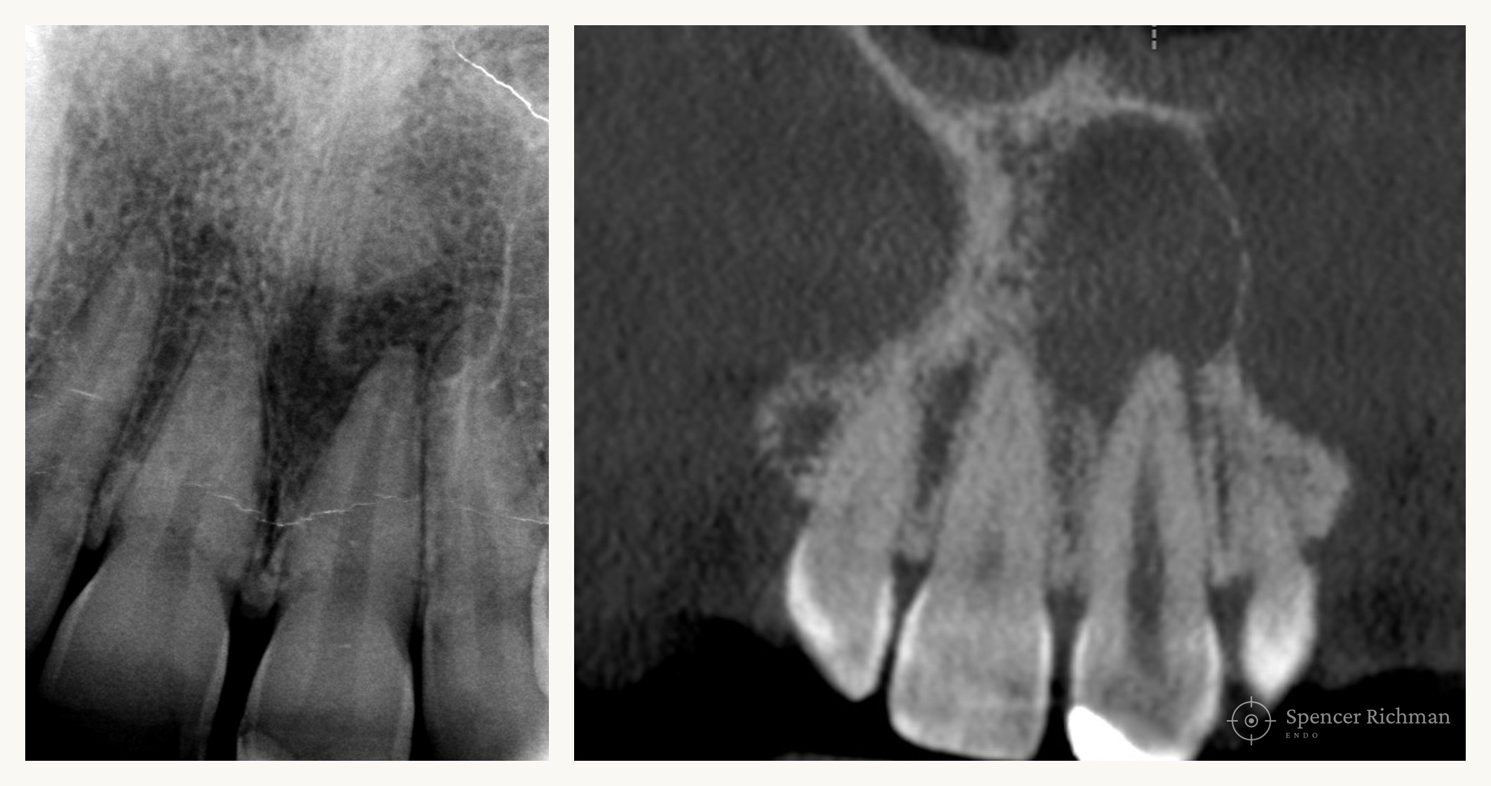 A periapical radiograph beside a CBCT image of the same upper front tooth, showing the true extent of a periapical infection around the root