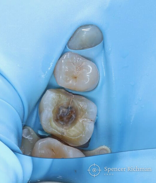 A cracked upper molar: root canal treatment and a same-day crown