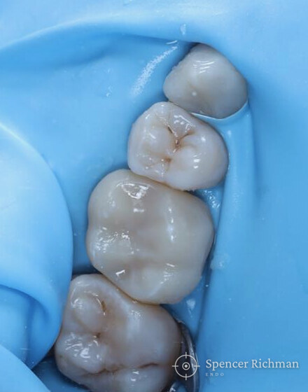 The restored upper molar under rubber dam with the all-ceramic crown fitted