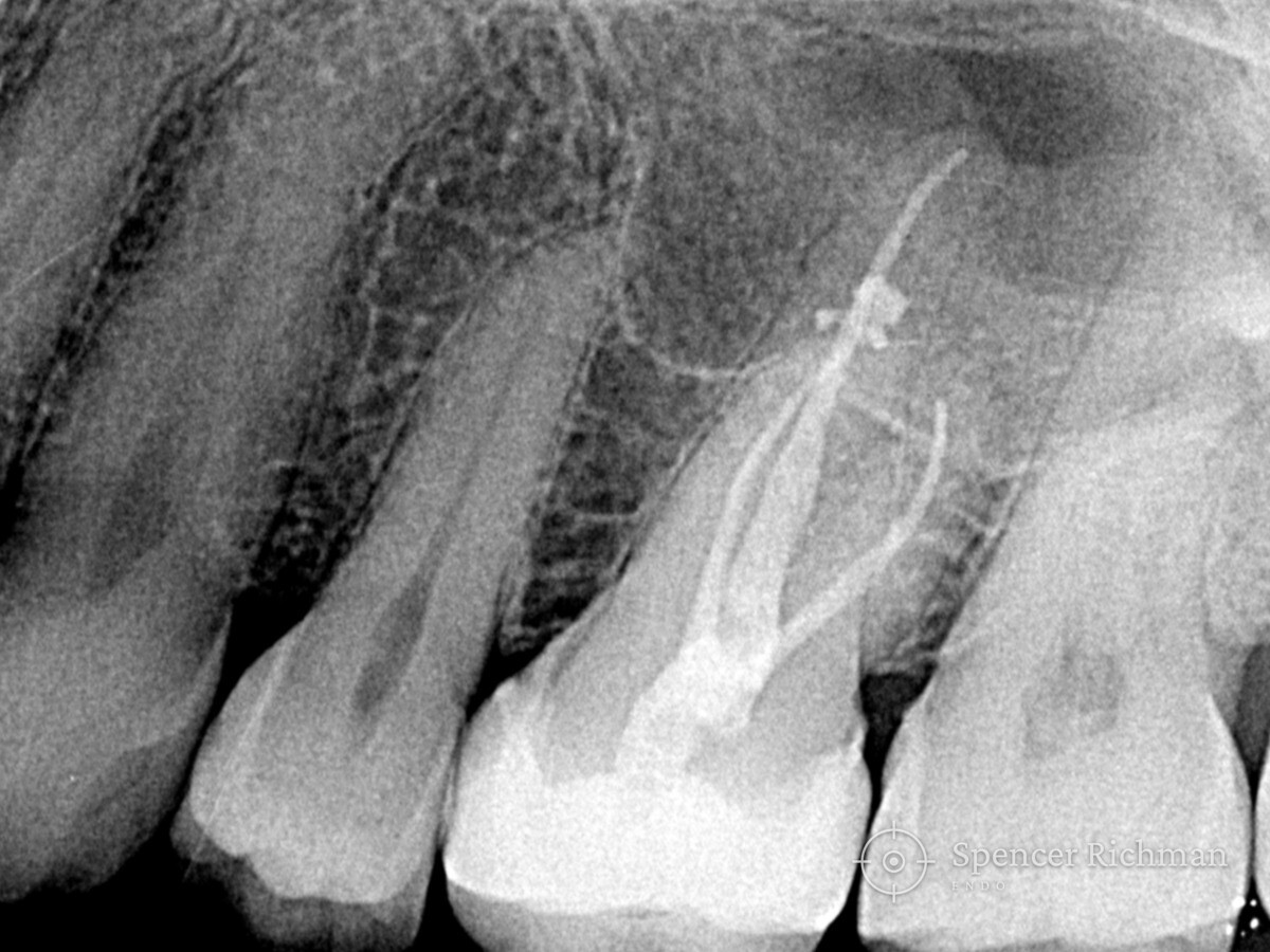Post-operative radiograph of the upper left first molar showing the completed root filling and the all-ceramic crown in place