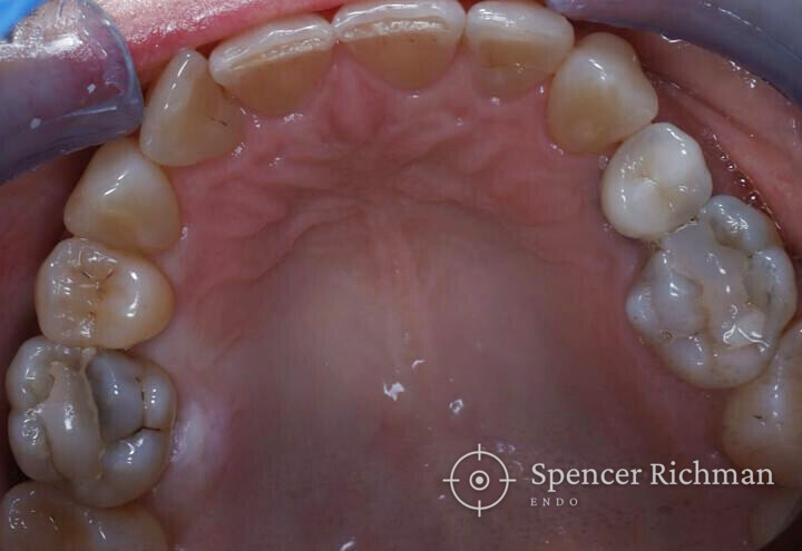 Occlusal view of the upper arch showing the affected first molar