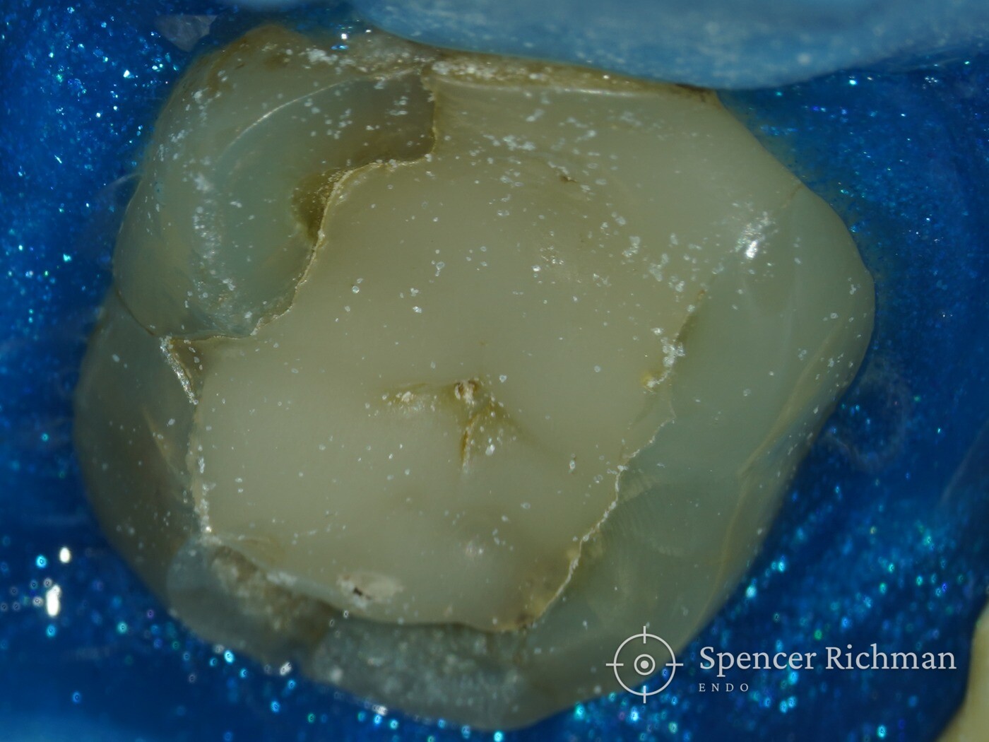 Compromised lower molar: root canal treatment to keep a strategically important tooth