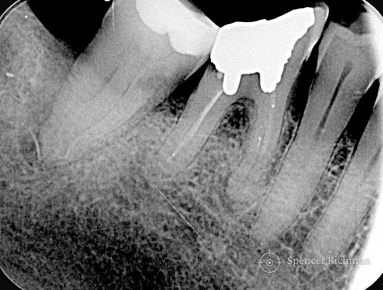 Pre-operative radiograph of the lower right second molar showing external inflammatory resorption