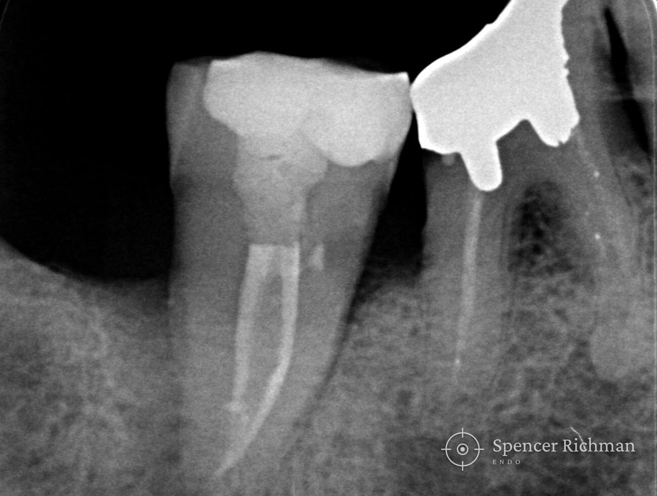Post-operative radiograph of the lower right second molar showing the completed root filling