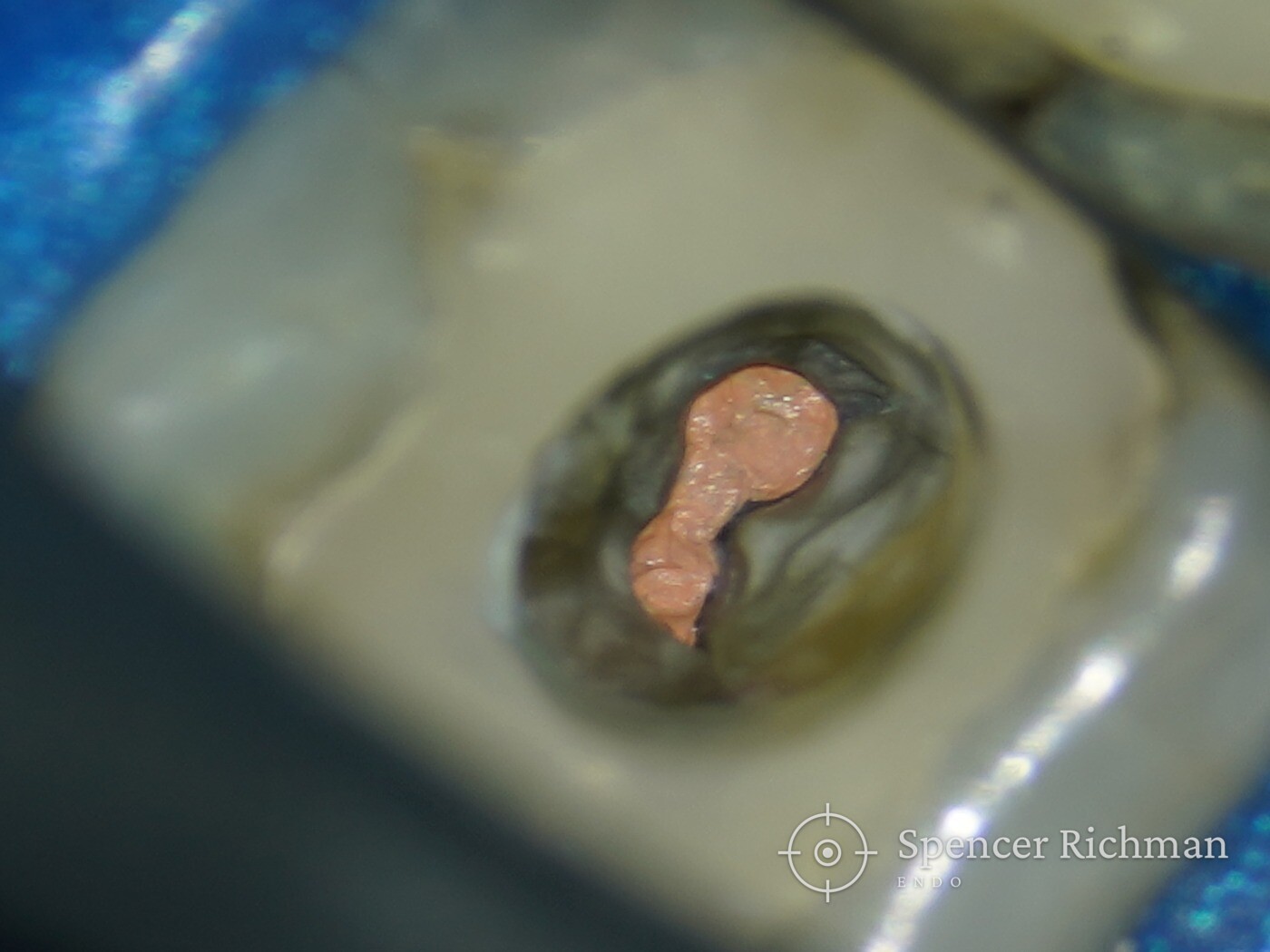 The completed root filling seen at the canal orifice