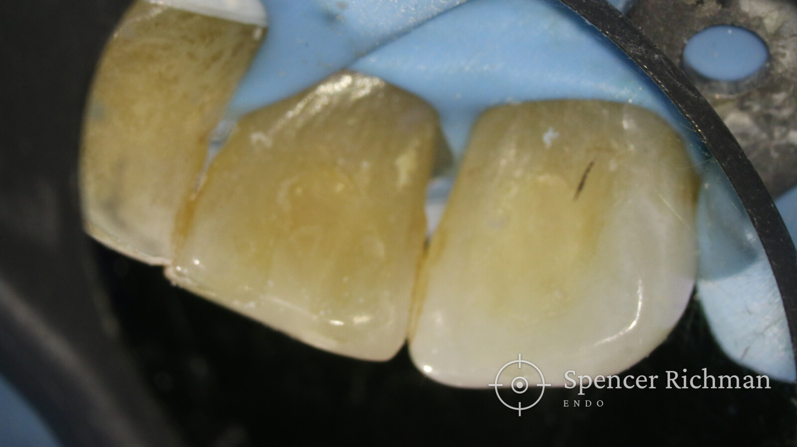 Root canal re-treatment: a lower incisor and canine after dental trauma