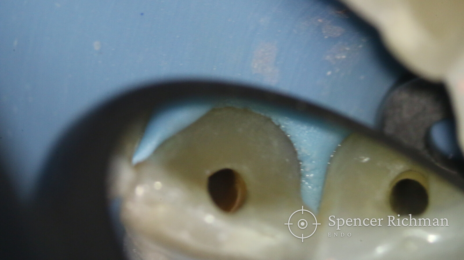 Both access cavities seen under the dental operating microscope