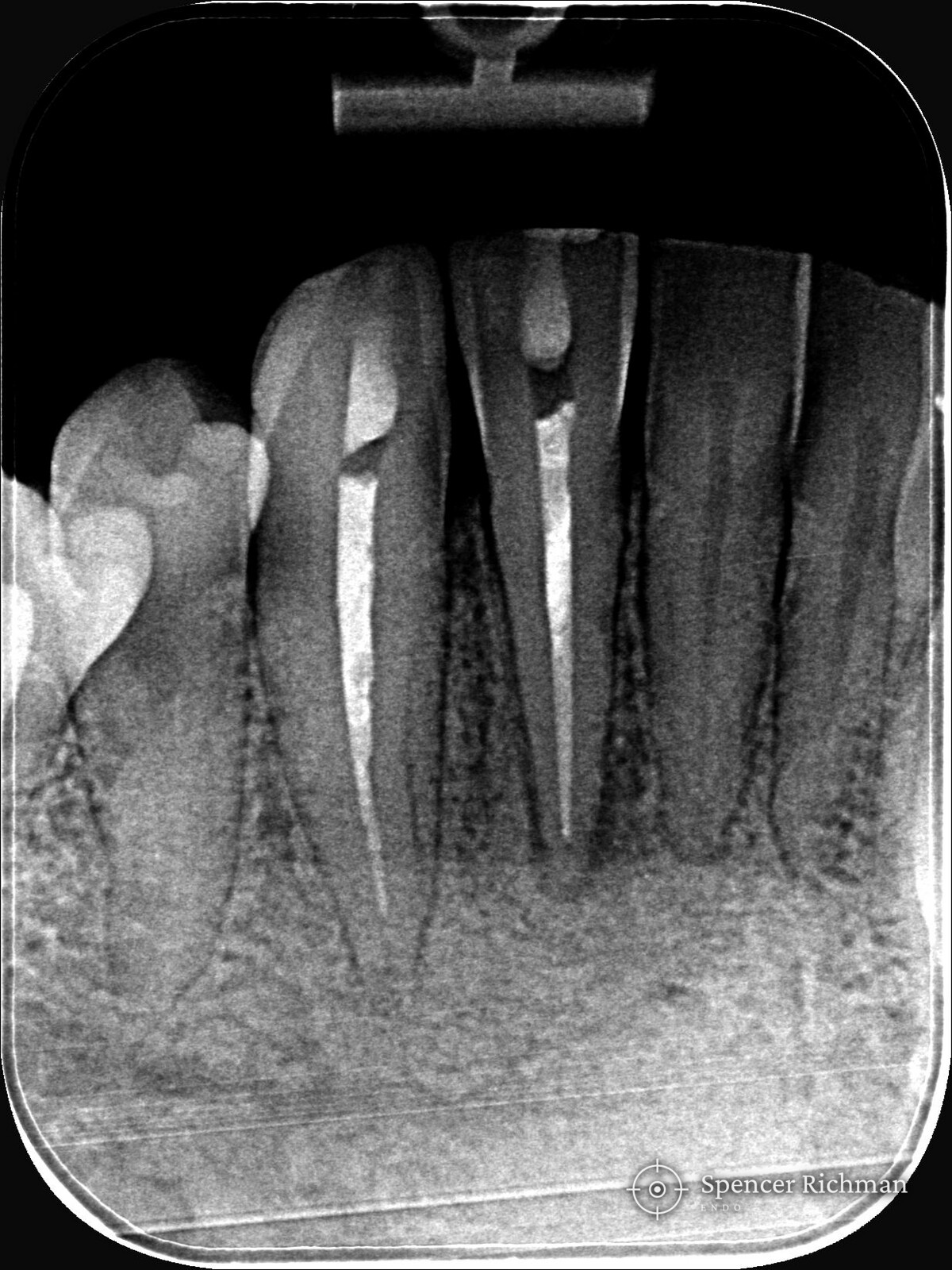 Pre-operative radiograph of the lower right lateral incisor and canine, both root fillings stopping short of the end of the root