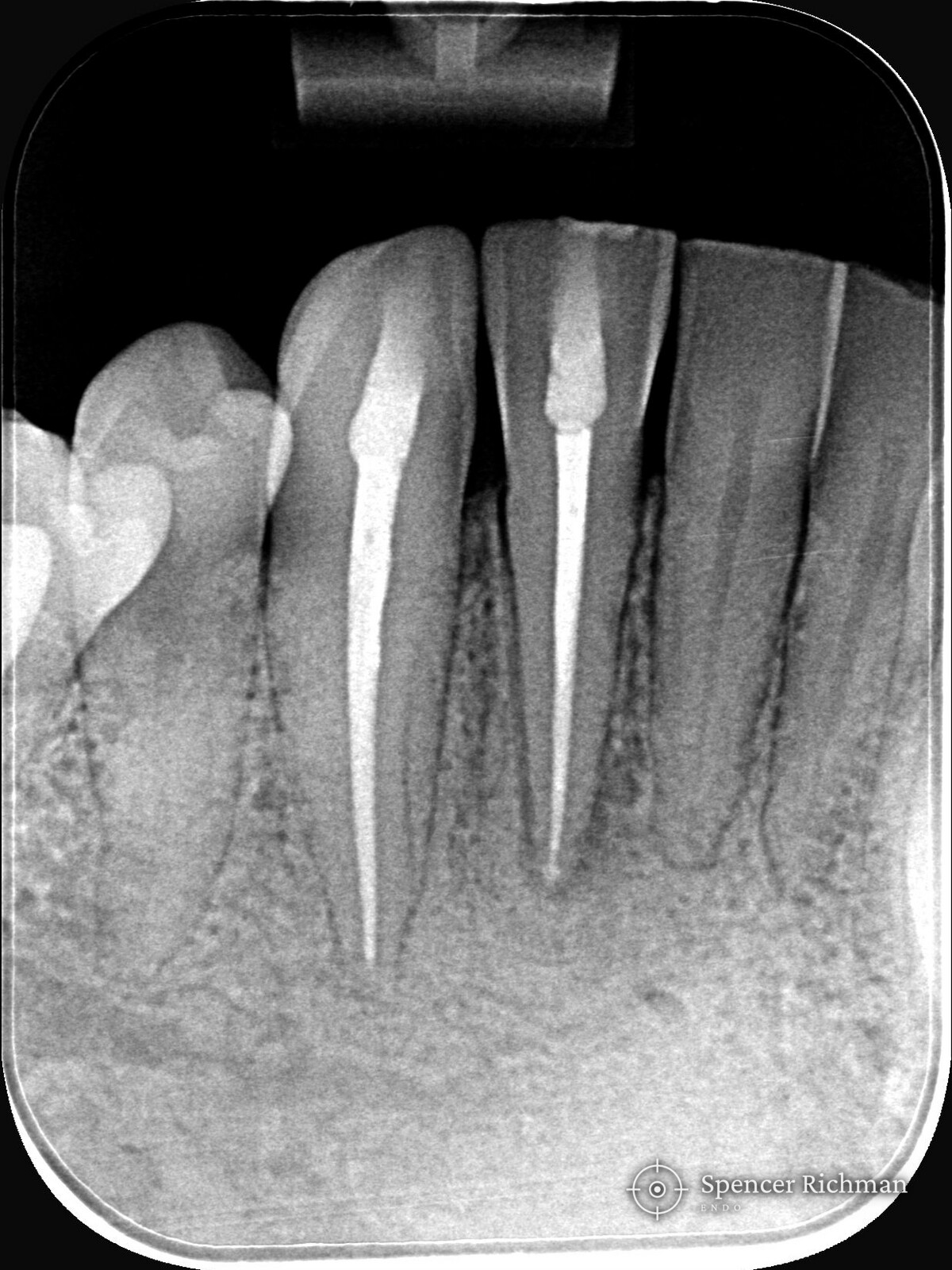 Post-operative radiograph of the lower right lateral incisor and canine, both canals re-treated and sealed to the end of the root