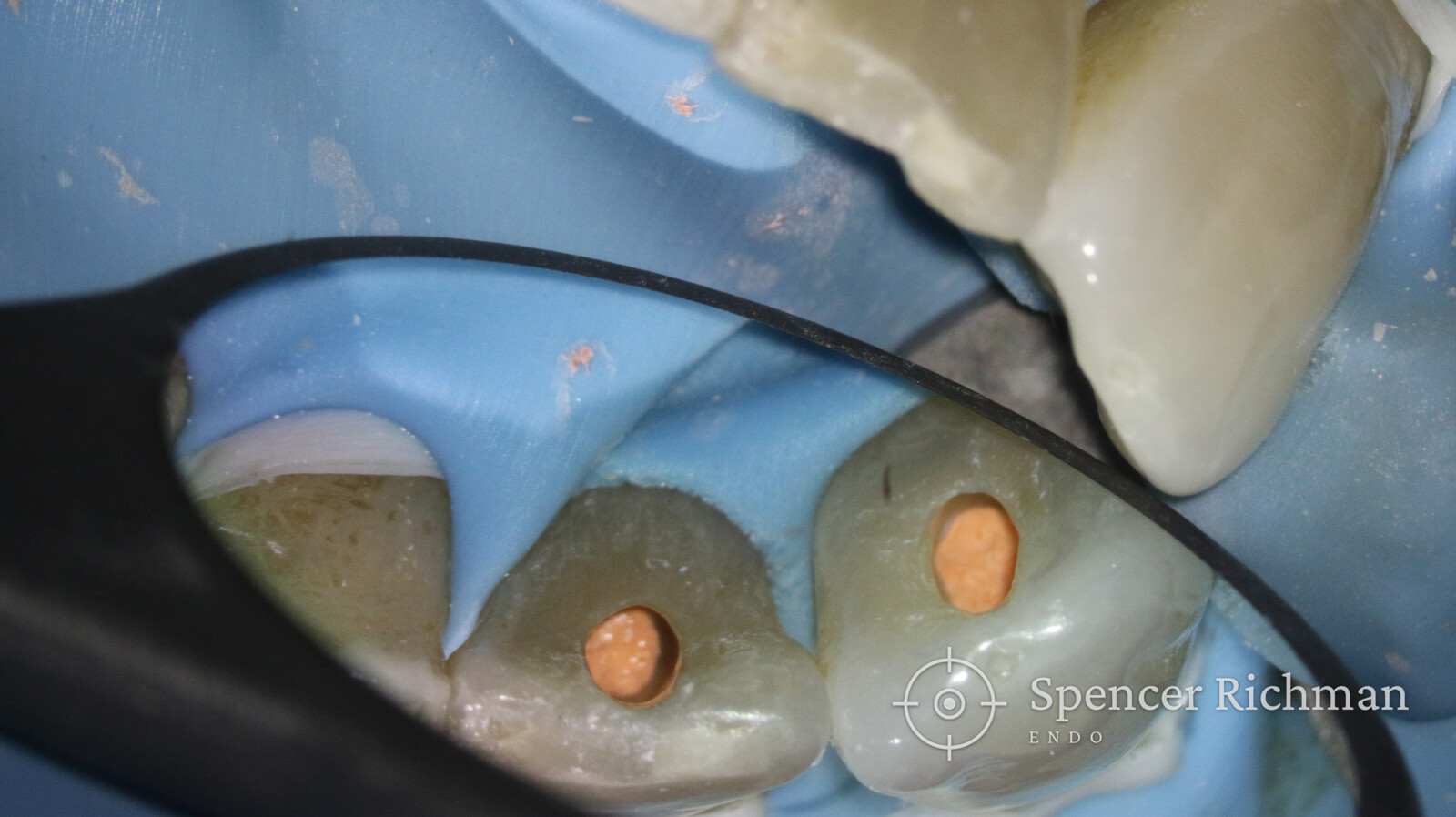 Both canals sealed at the end of re-treatment