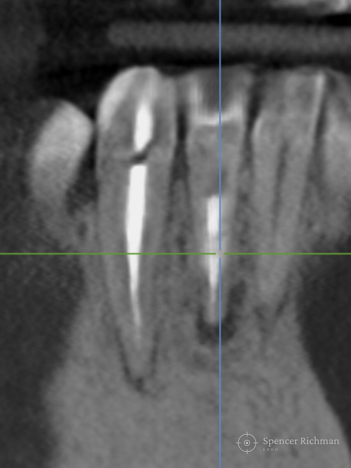 CBCT slice showing inflammation in the bone around the end of both roots