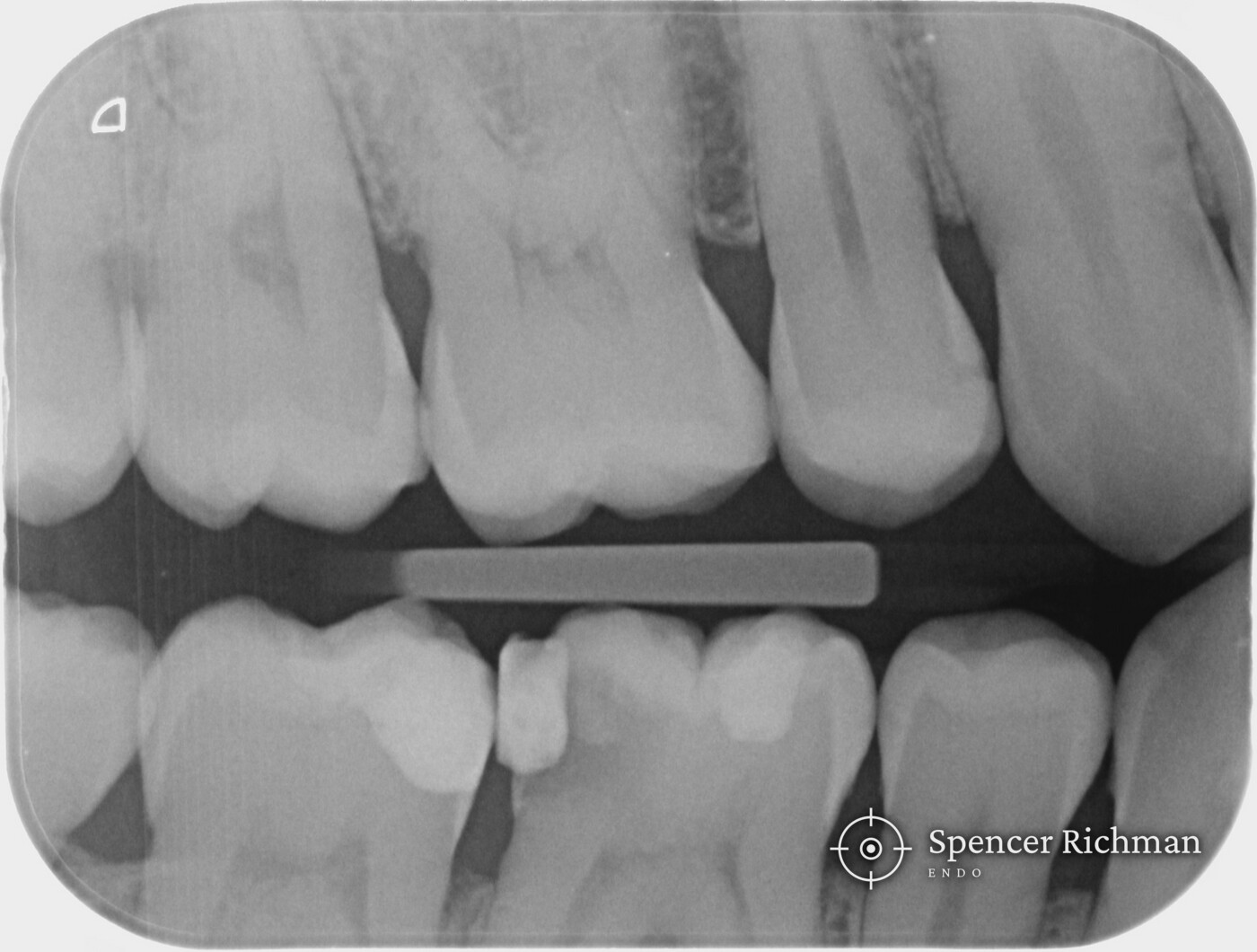 Deep decay in a lower molar: root canal treatment in a single visit