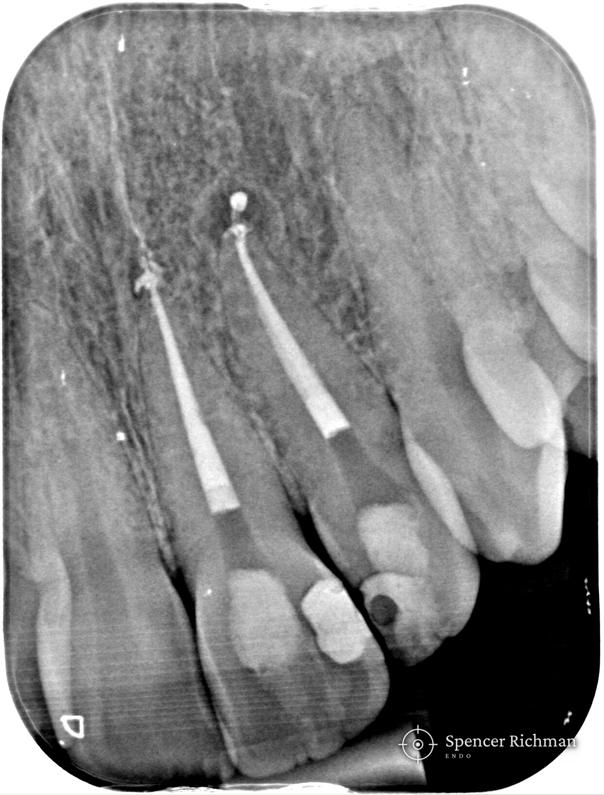 Periapical radiograph of the upper left central and lateral incisors after re-treatment, both canals sealed to the end of the root