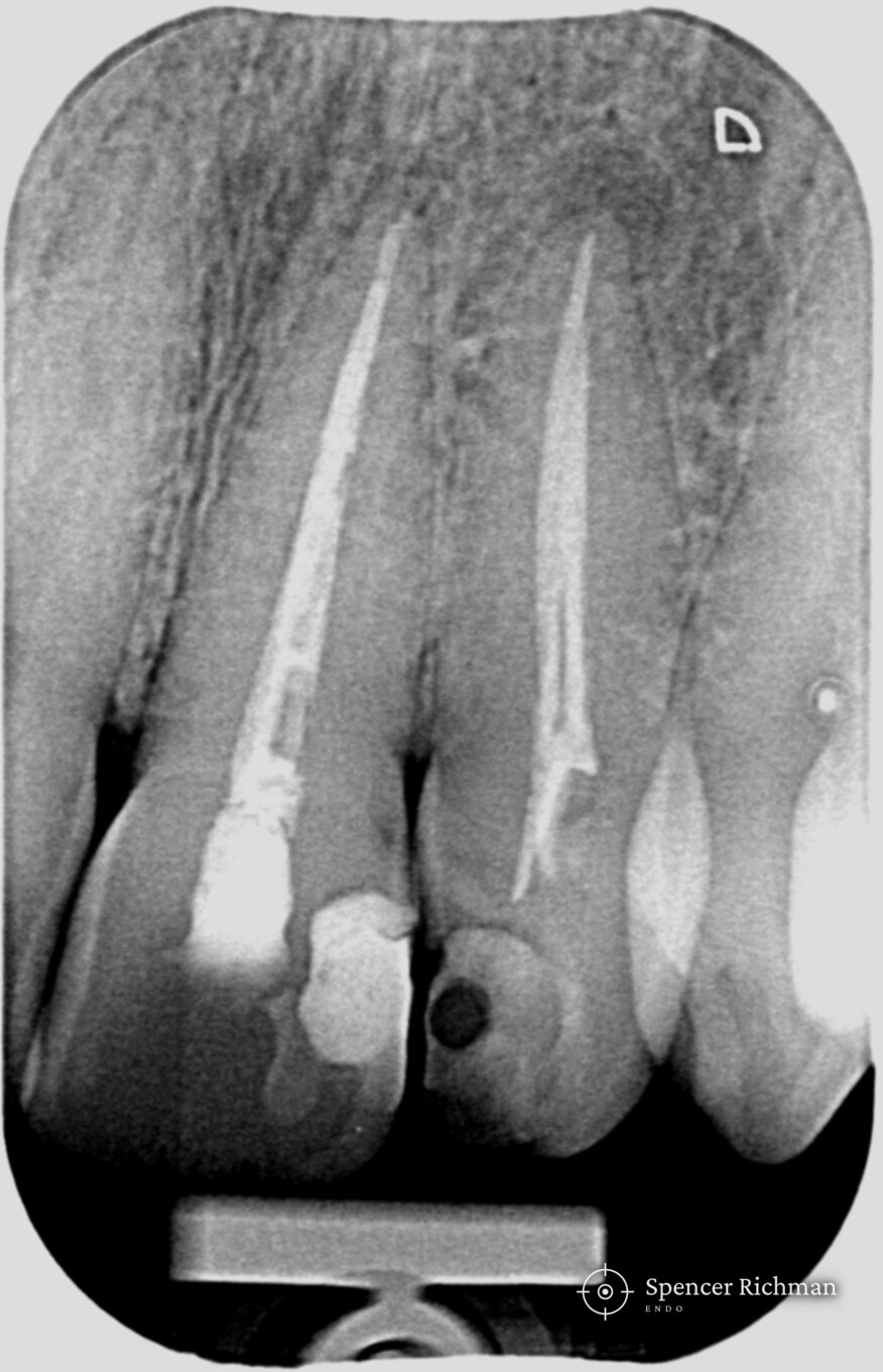 Upper front teeth: root canal re-treatment fifteen years on