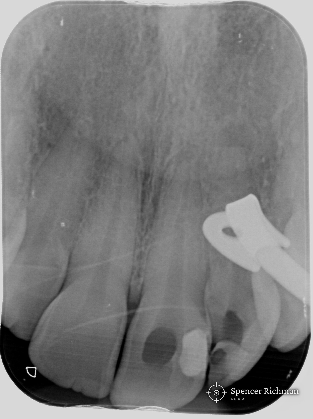 Periapical radiograph of the upper left central and lateral incisors with both canals emptied of the original filling material