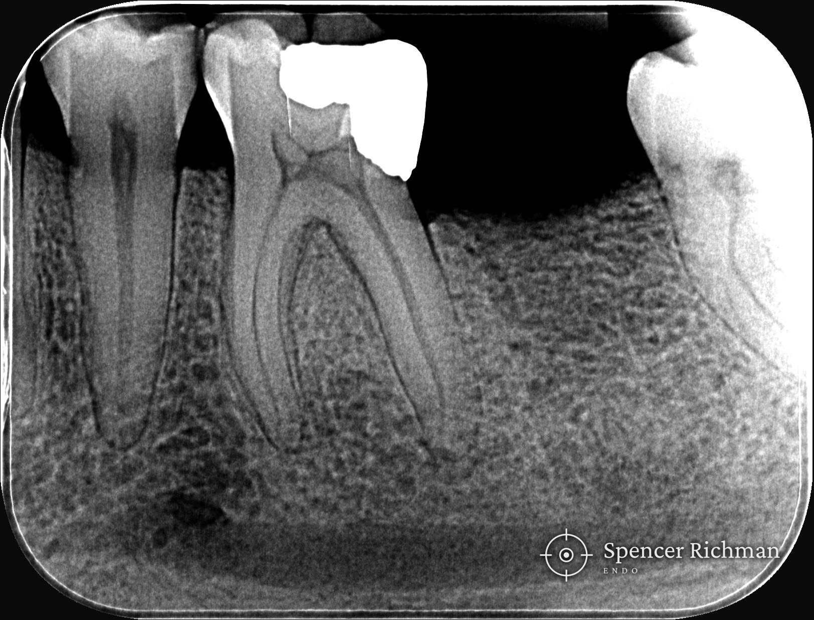 Periapical radiograph of a lower left first molar, with a deep amalgam filling running toward the pulp chamber