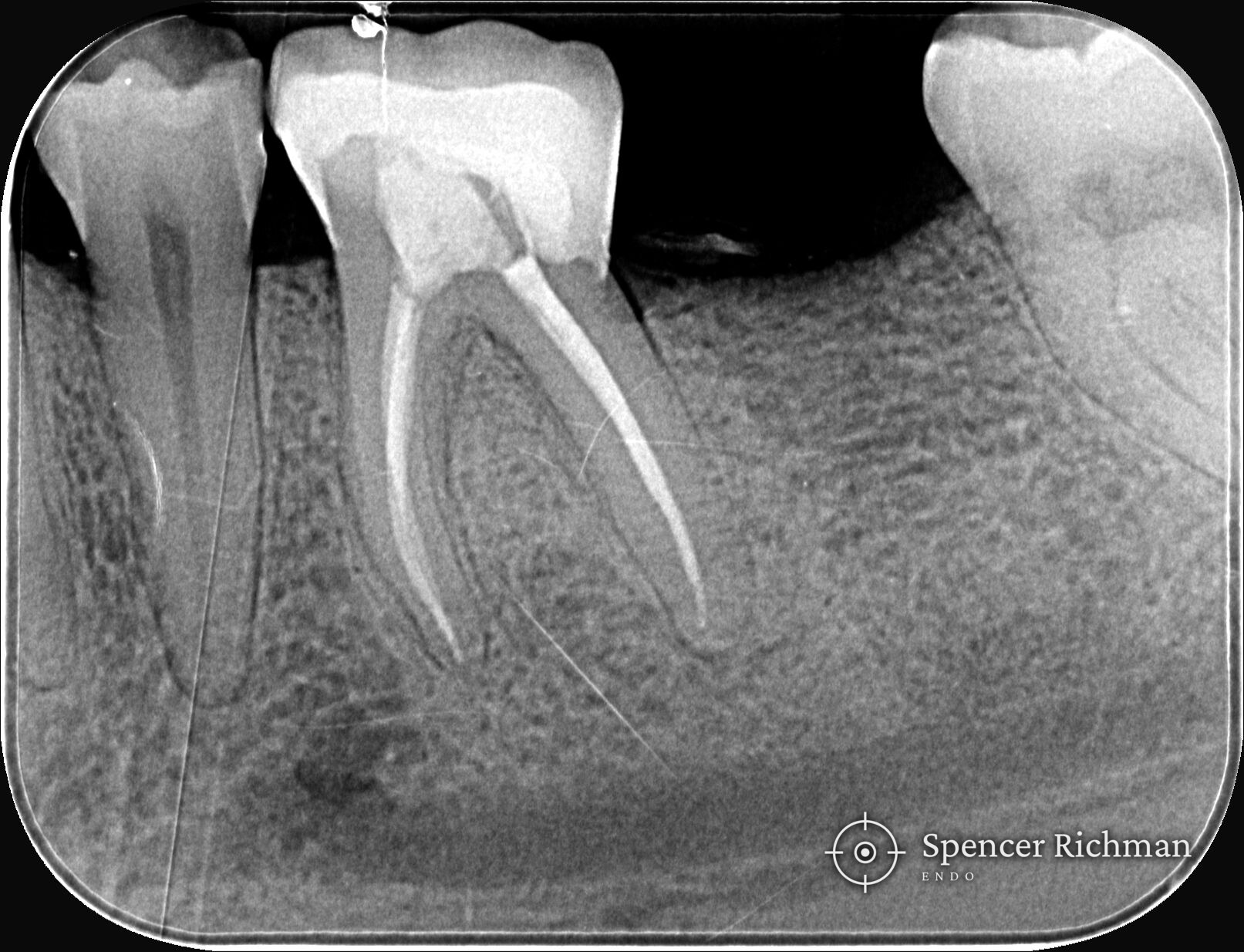 Periapical radiograph of a lower left first molar after root canal treatment, with the canals sealed and a crown fitted