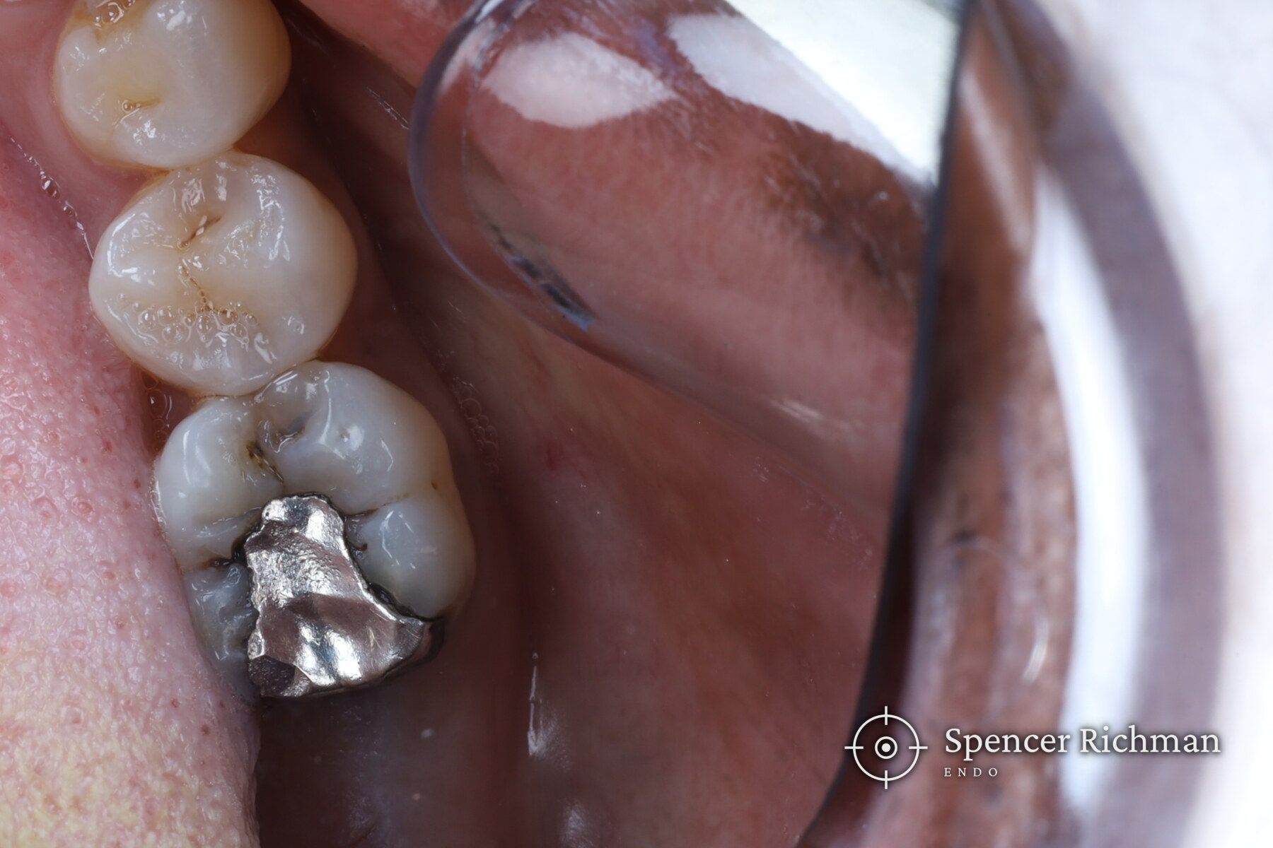 A nervous patient: root canal treatment and a crown in one visit, without sedation