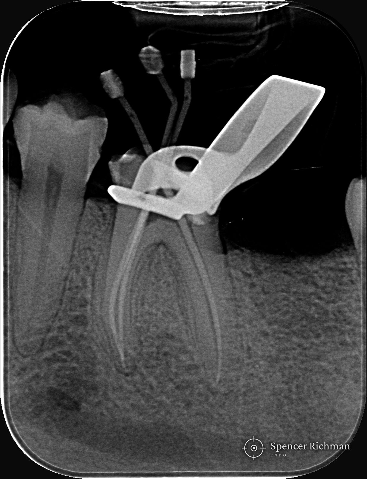 Check radiograph of a lower left first molar during root canal treatment, with points placed to confirm working length