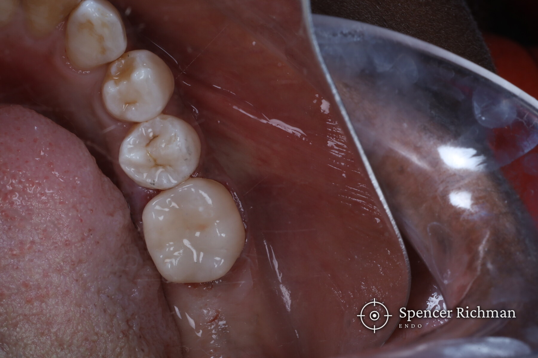 Lower left first molar restored with a crown at the end of the same visit