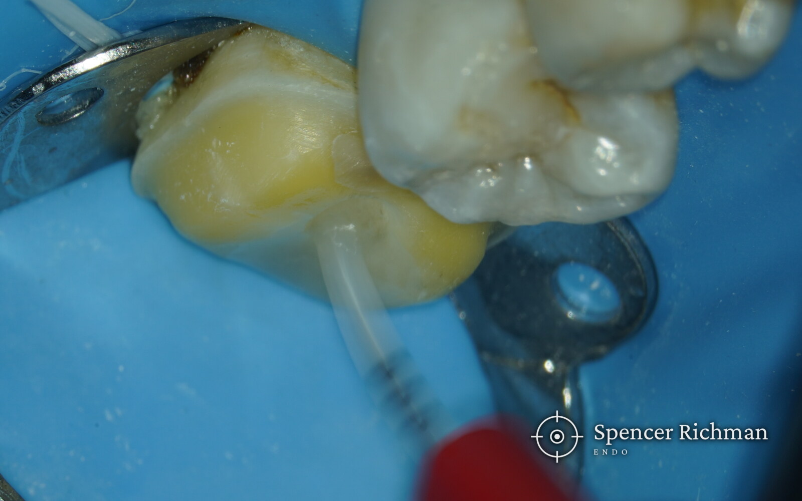 A sonic tip activating the irrigant inside the access cavity of a lower left first molar under rubber dam