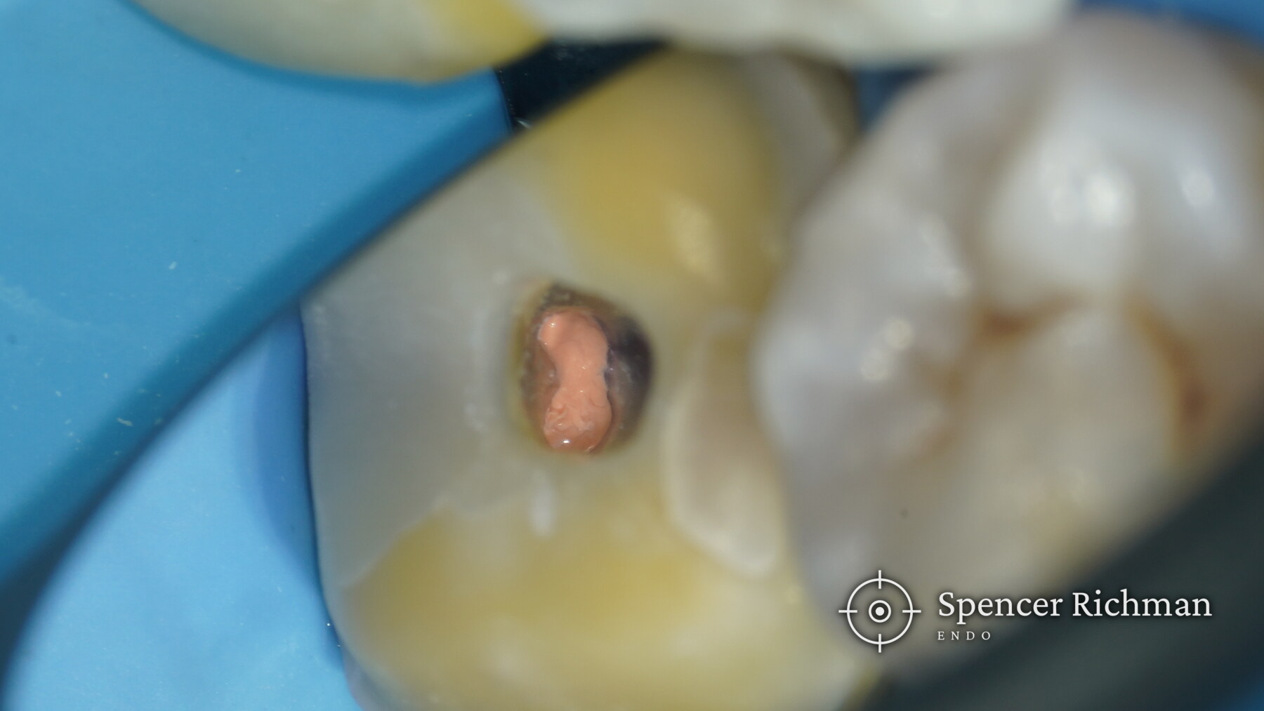 Lower left first molar under rubber dam with all four canals sealed at the end of treatment