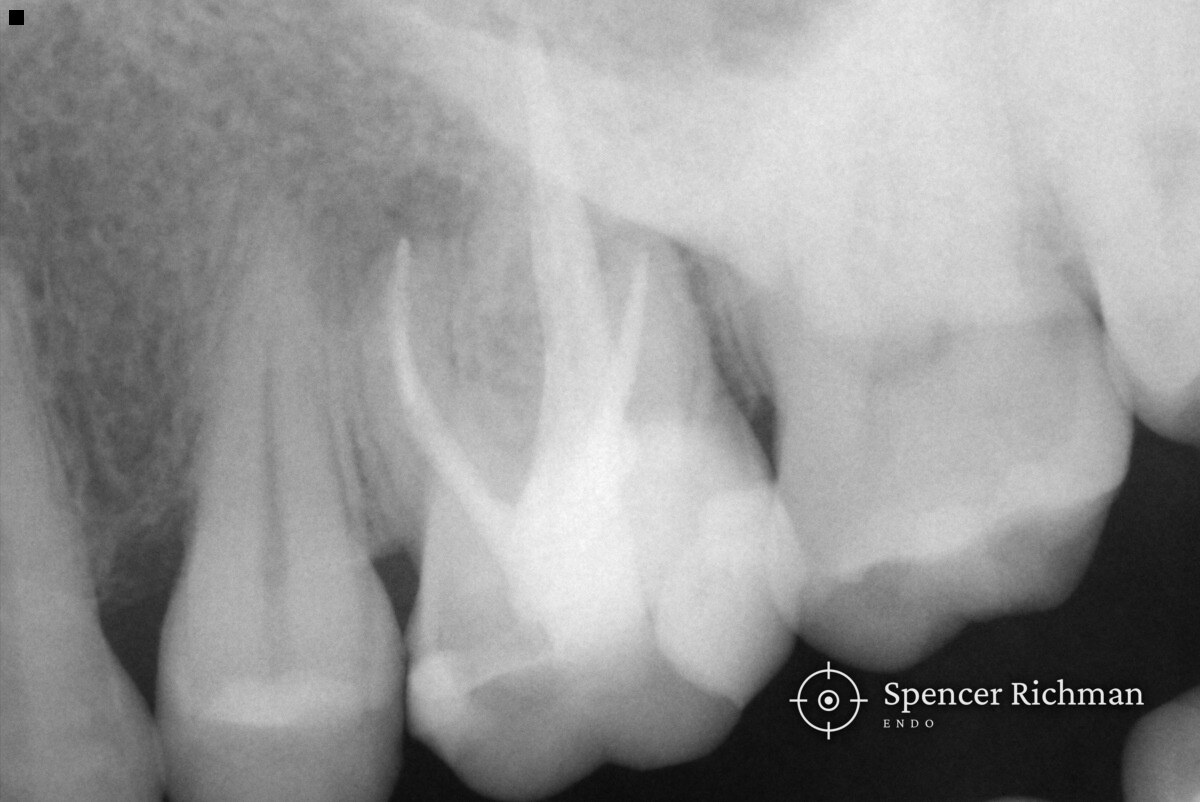 Periapical radiograph of an upper left first molar root treated thirteen years earlier, with apical pathology on the mesio-buccal root