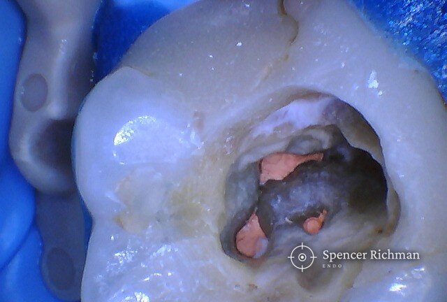 An upper molar with a missed canal: root canal re-treatment thirteen years on