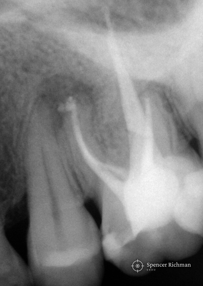 Periapical radiograph of an upper left first molar after root canal re-treatment, with the second mesio-buccal canal filled