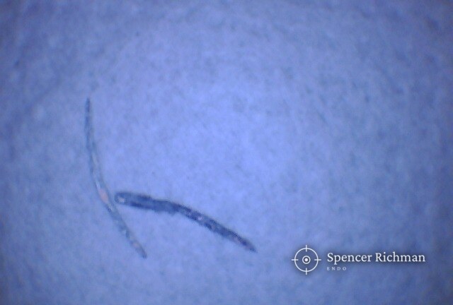 Two plastic carriers removed whole from the canals of an upper left first molar during root canal re-treatment