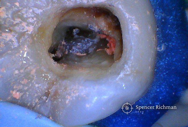 Pulp chamber of an upper left first molar as found, filled with old root filling material before re-treatment