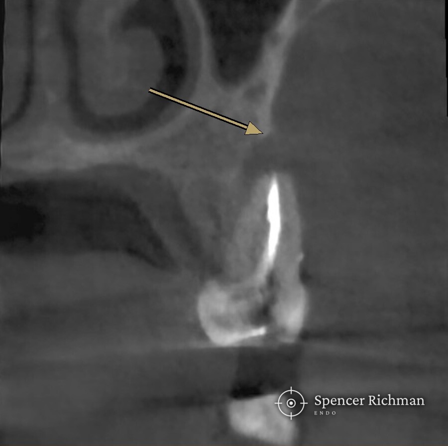 CBCT slice of an upper left first molar, with an arrow marking the change in the bone at the end of the mesio-buccal root