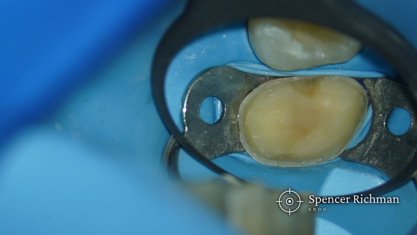 A cracked upper molar from grinding: root canal treatment in a young patient