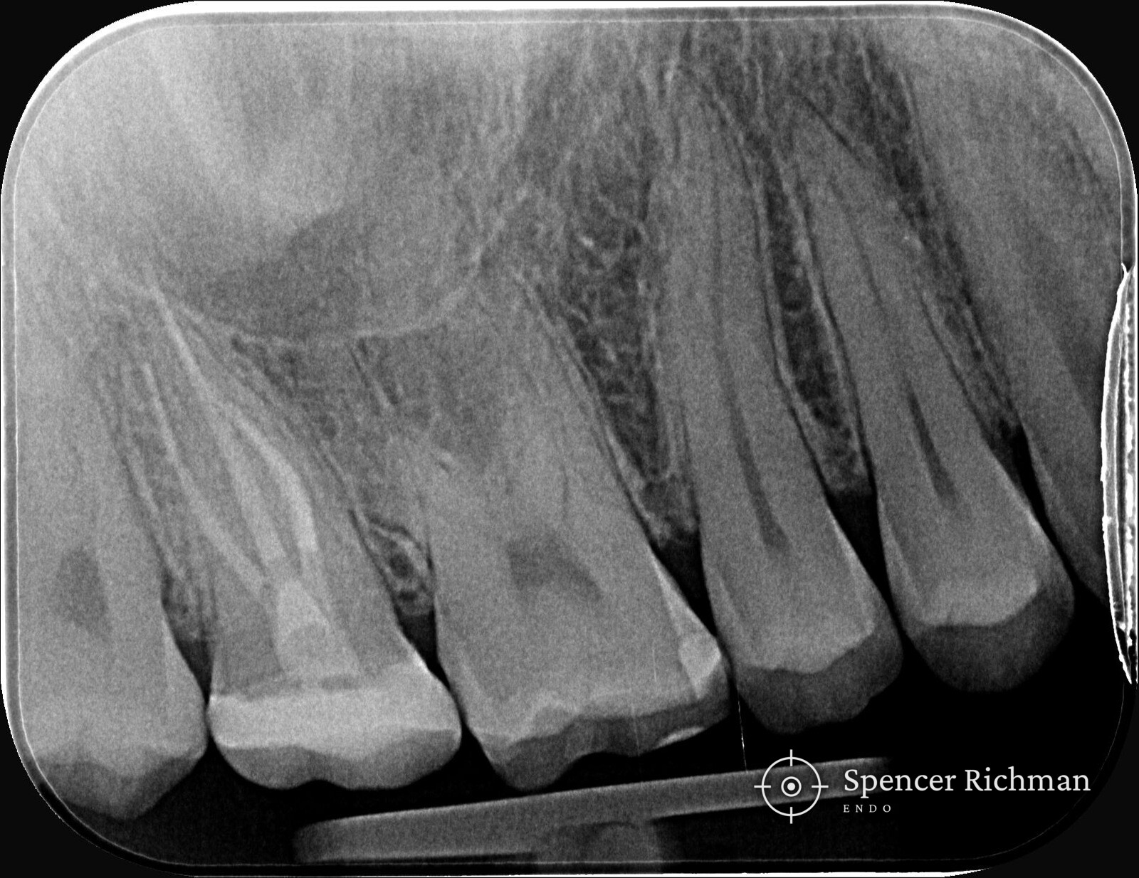 Periapical radiograph of an upper right second molar after root canal treatment, with the onlay fitted at the same visit