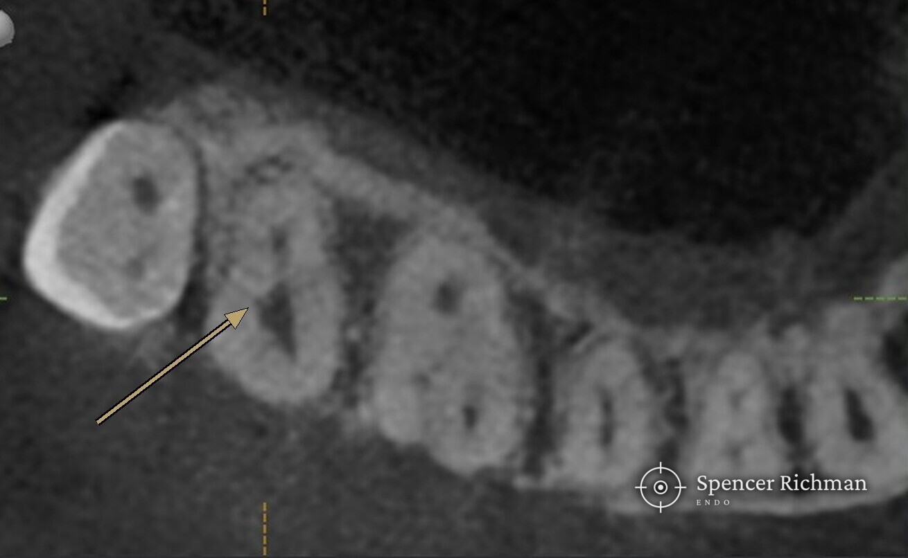 CBCT slice through an upper right second molar, with an arrow marking the crack running into the pulp