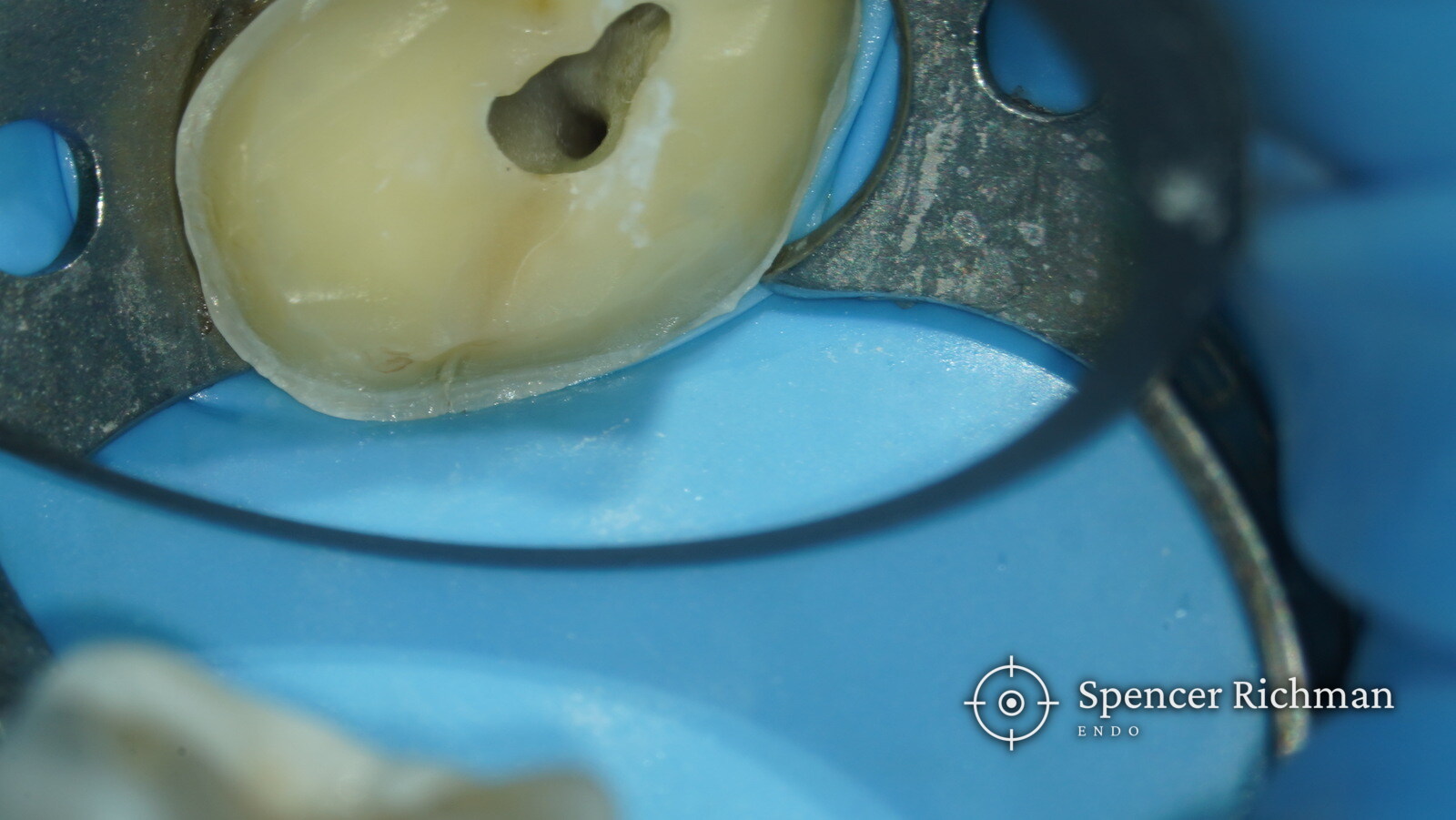 Access cavity of an upper right second molar under rubber dam and the dental operating microscope