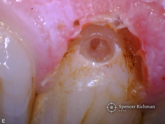 An upper front tooth: external cervical resorption after a teenage injury