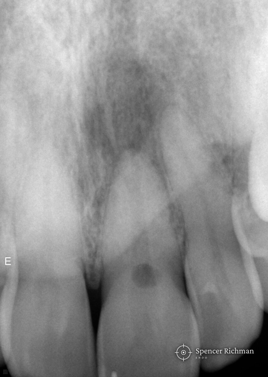 Periapical radiograph of an upper left central incisor showing external cervical resorption at the neck of the tooth and infection at the root end