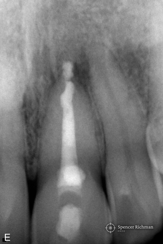 Periapical radiograph of an upper left central incisor after root canal treatment, with the resorptive defect repaired in composite
