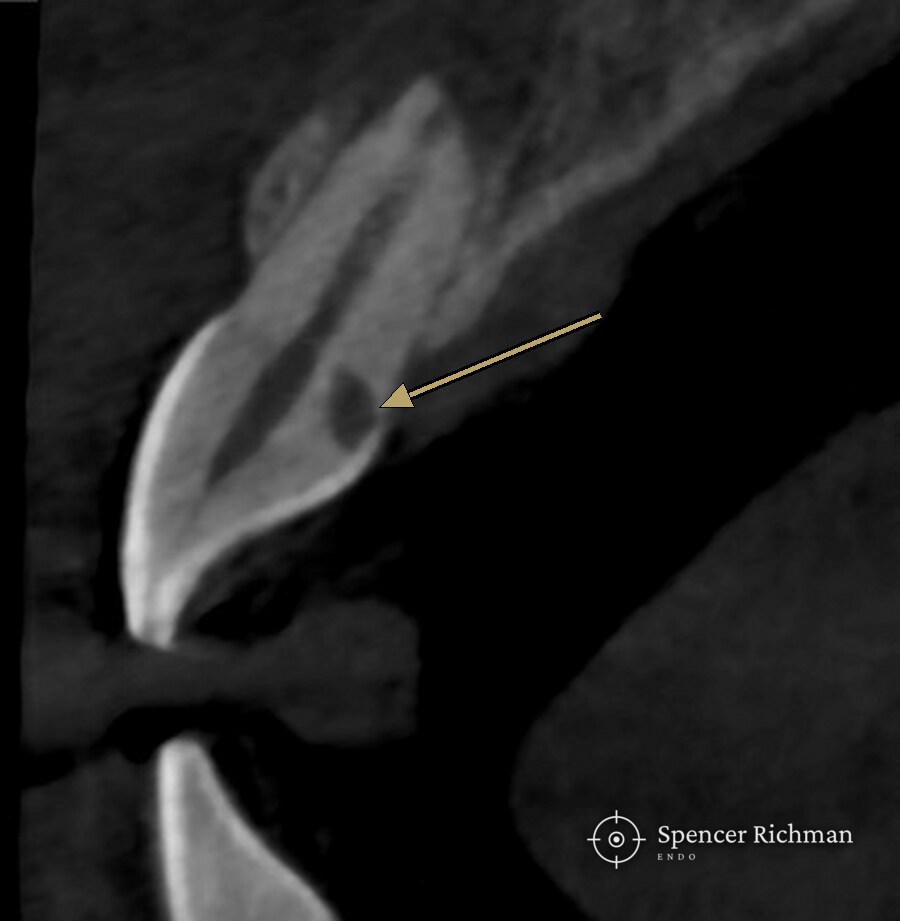 CBCT slice through an upper left central incisor, with an arrow marking the resorptive defect on the palatal surface