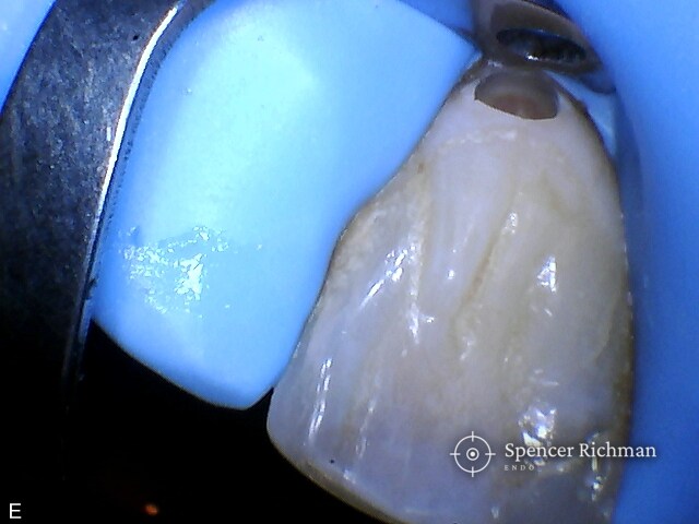 Upper left central incisor isolated under rubber dam before treatment