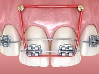 Close-up illustration of upper front teeth with orthodontic braces and red elastic rubber bands forming a rectangular configuration for dental correction.