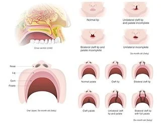 Medical illustration depicting cleft lip and palate conditions, showing cross-sections and external views: normal lip, unilateral cleft lip and palate incomplete, bilateral cleft lip and palate incomplete, normal palate, cleft lip, bilateral cleft lip, cleft palate, unilateral cleft lip and palate, and bilateral cleft lip with full palate. The diagram includes labels for nose, lip, gum, palate, and depicts a newborn with a cleft lip and a newborn with a bilateral cleft lip and palate.
