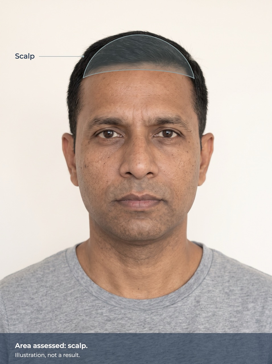 Illustration of the area assessed: scalp. Illustration, not a result.
