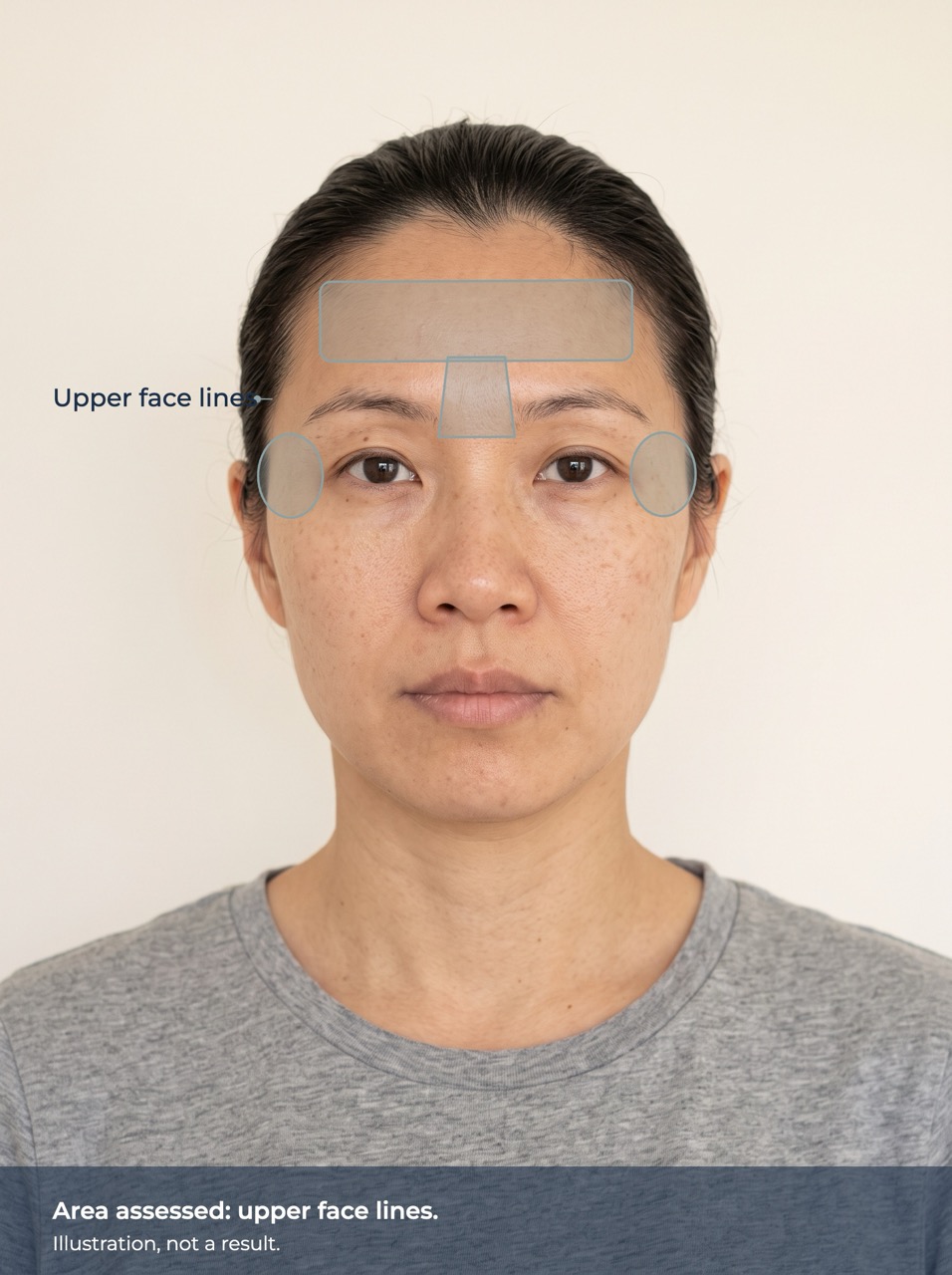 Illustration of the area assessed: upper face lines. Illustration, not a result.