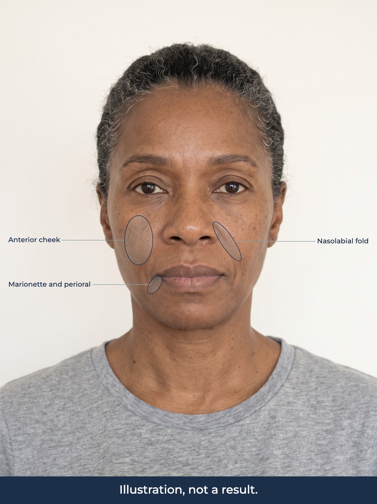 Illustration of the anterior cheek, nasolabial folds and the marionette and perioral area marked on a face. Illustration, not a result.