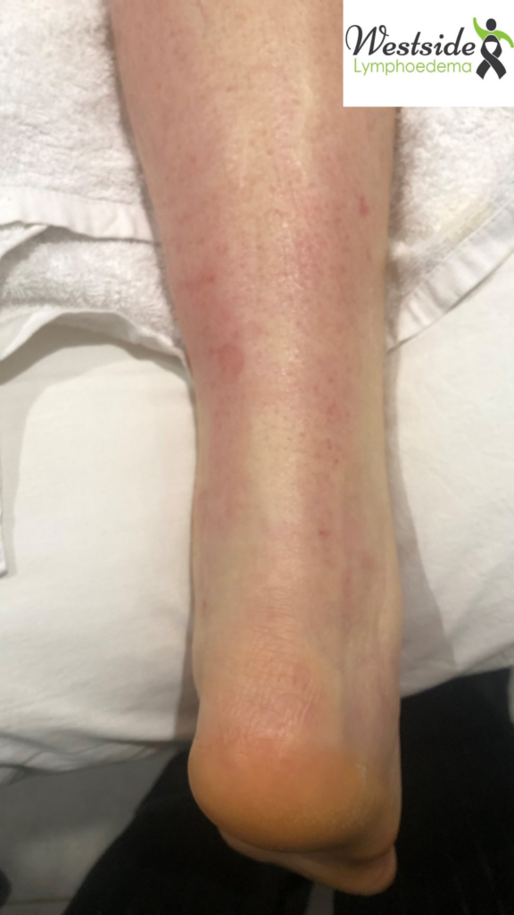 The same lower leg after LymphaTouch treatment